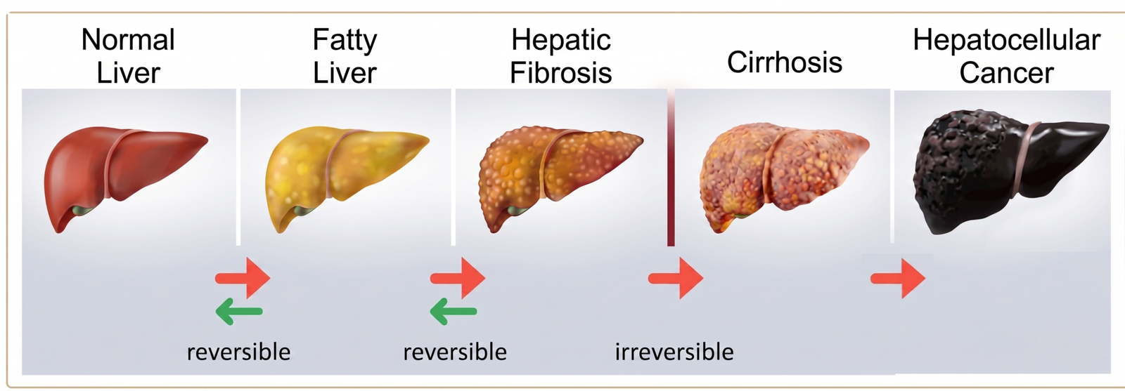 Fatty liver progression